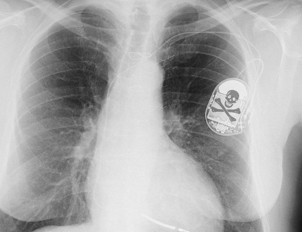 RT @doctorow: Pacemakers and Piracy: The Unintende…